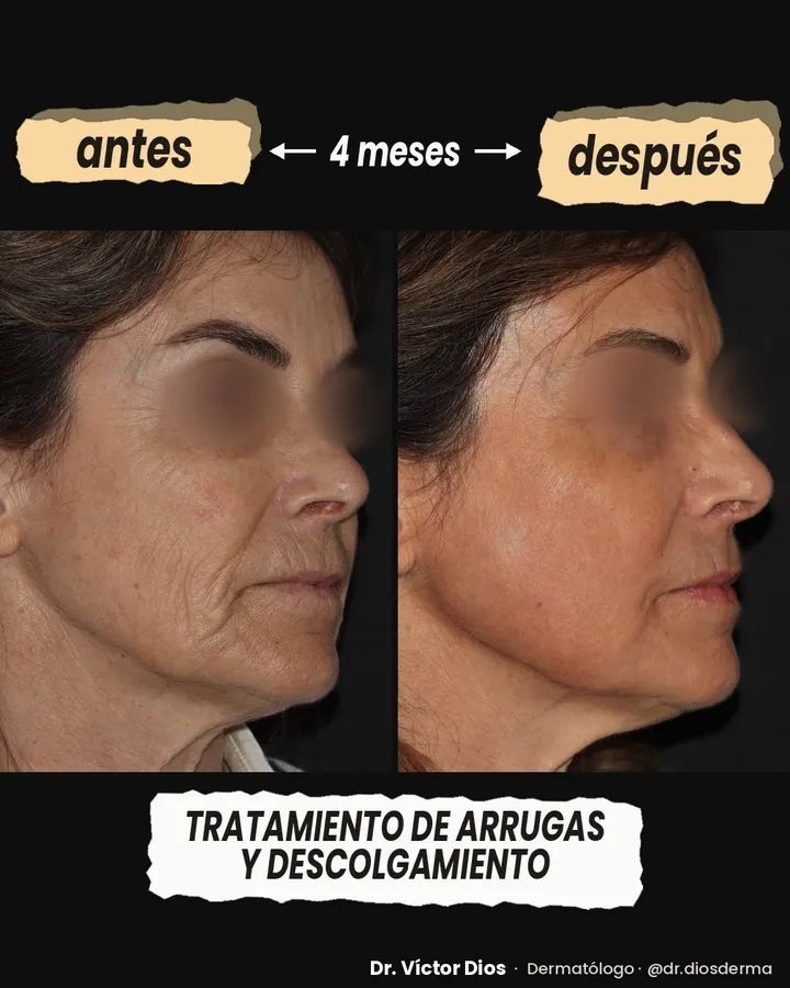 Antes y después de tratamiento de arrugas y descolgamiento con láser CO2
