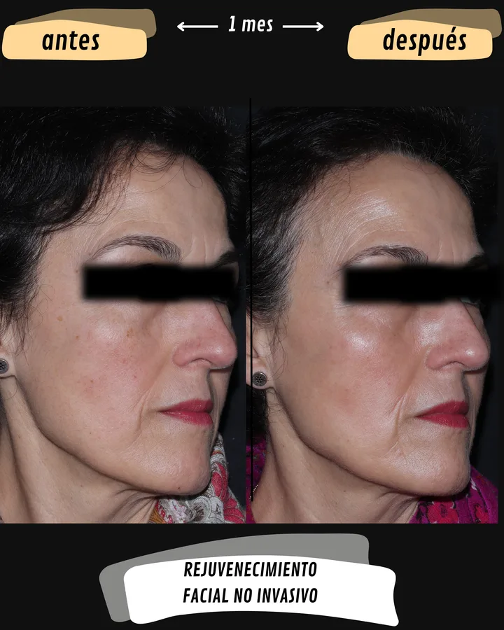 Antes y después de rejuvenecimiento facial, vista lateral derecha